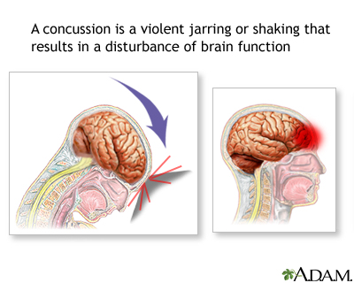 Concussions, Headaches and Migraines, and Their Treatments