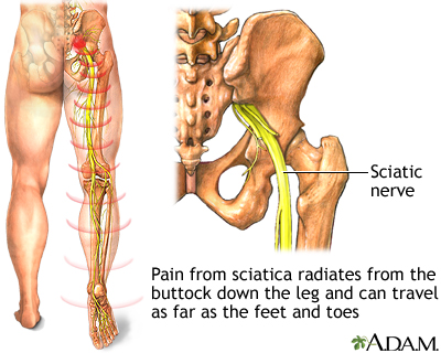 Sciatica (Leg Pain)