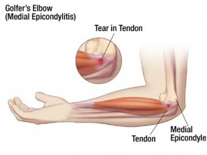 Golfer's Elbow, medial epicondylitis