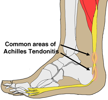 Achilles Tendonitis