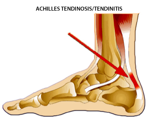 Achilles Tendonitis