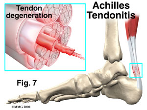 achilles_tendonitis (1)