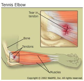 tennis elbow, lateral epicondylitis