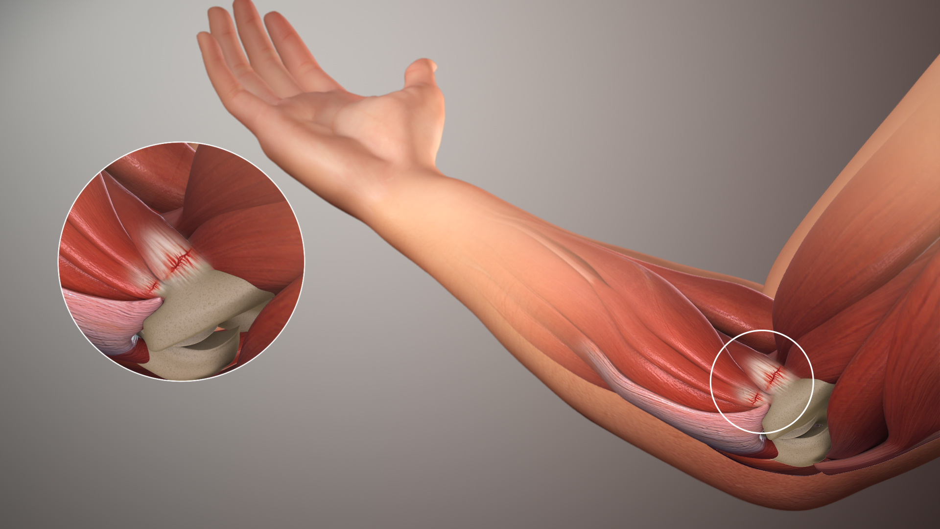 Understanding Elbow Pain