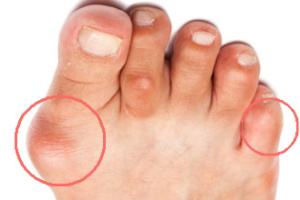 how_to_get_rid_of_a_bunion