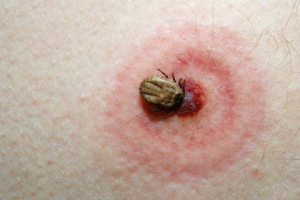 lyme-disease-symptom-300x200