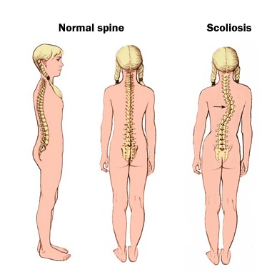Patient Testimonial: Chronic Pain and Scoliosis
