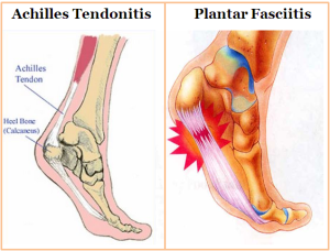 achilles tendon running injury