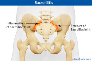sacroiliac3