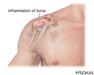 shoulerbursitis2