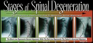 spinal-degeneration