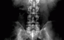 xray spine, chiropractic for low back pain