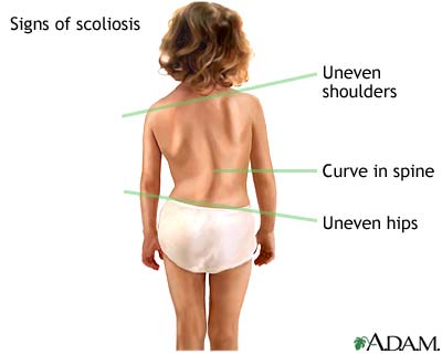 scoliosis_signs