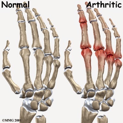 Arthritis