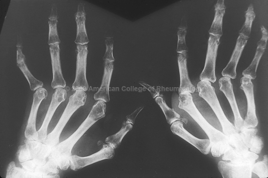 Metacarpophalangeal Joint Arthritis (MCP)