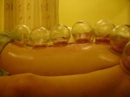 cupping therapy, chinese medicine