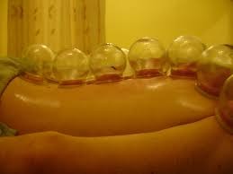 cupping