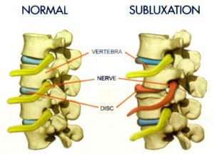 vertebral-subluxation