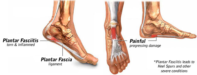 Plantar Fasciitis Stretches