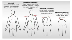 scoliosis