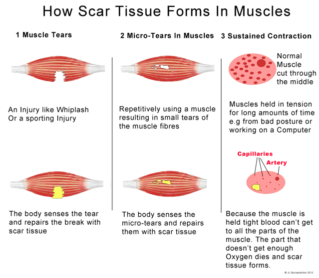 scar-tissue